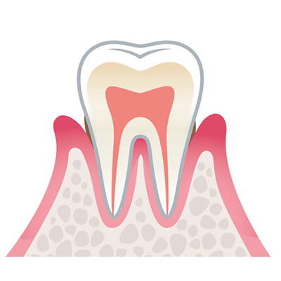 軽度歯周病の画像